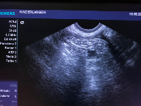 Eileiterdurchgängigkeit Ultraschall (3)